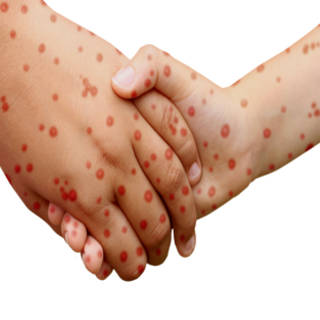 0527 Measles Outbreak TN