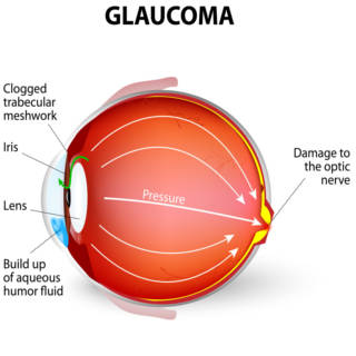 0417 Glaucoma TN
