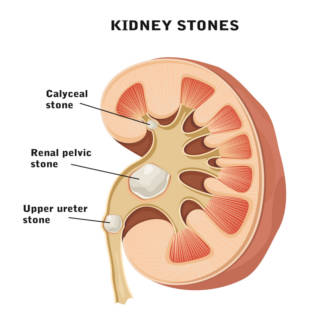 0806 Kidney Stones TN
