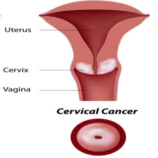 1016 Cervical Cancer TN