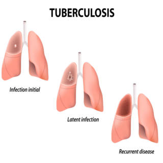 0514 Tuberculosis TN
