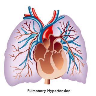 0204   Pulmonary Hypertension TN